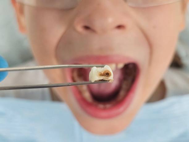 Best Emergency Treatment for Dental Infections or Abscesses in Hawkinsville, GA